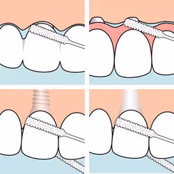 Tepe Filo Per Ponti E Impianti per Apparecchi dei Denti 30 Pezzi