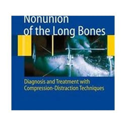ISBN Nonunion of the Long Bones : Diagnosis And Treatment With Compression-Distraction Techniques libro Medicina Inglese Copertina rigida